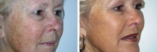 facelift-43a