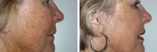facelift-43b